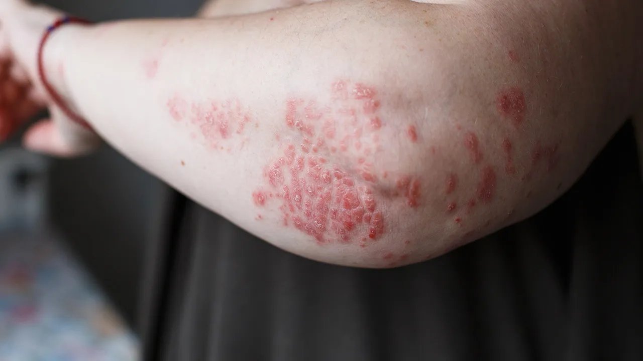 银屑病的症状有哪些