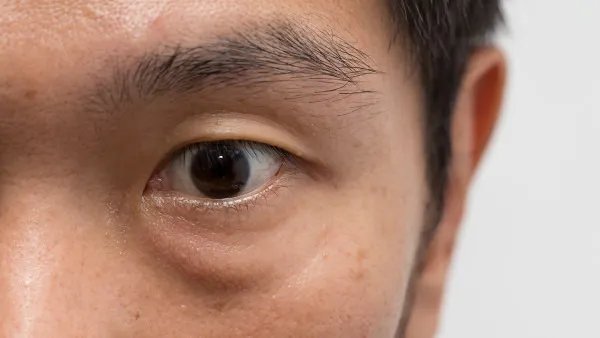 怎么除眼袋