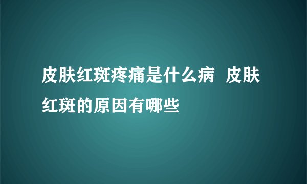 皮肤红斑疼痛是什么病  皮肤红斑的原因有哪些