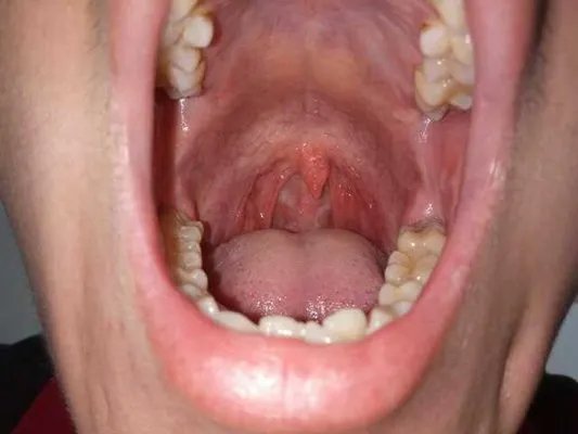 呼吸衰竭的症状?