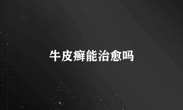 牛皮癣能治愈吗