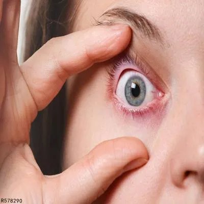 春季卡他性结膜炎的病发原因有哪些
