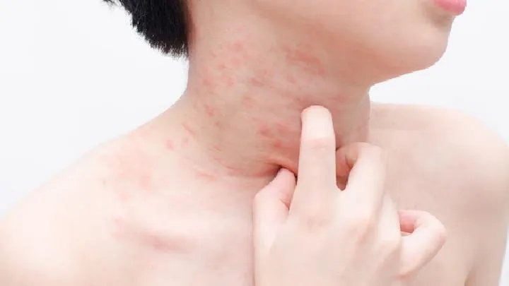 专家带您了解干燥性湿疹知识