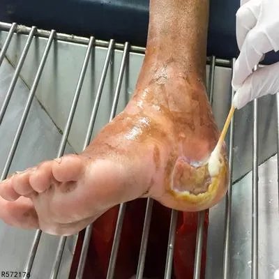 糖尿病老烂脚如何治疗 糖尿病老烂脚的3个控制方法揭秘